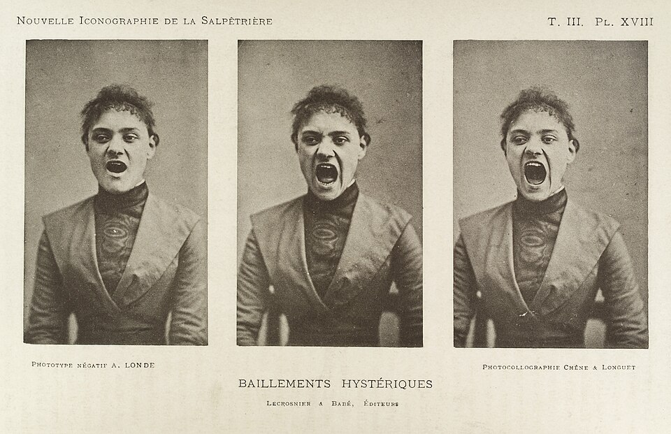 Trois photos d'une série montrant une femme hystérique en train de bâiller. Vers 1890. Source : Hôpital Pitié-Salpêtrière, Collection Bourneville.